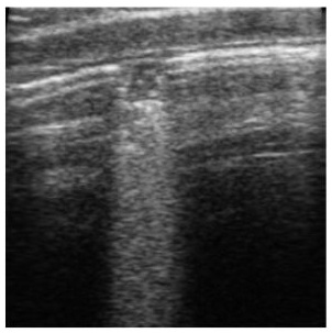 An ultrasound showing lung damage.